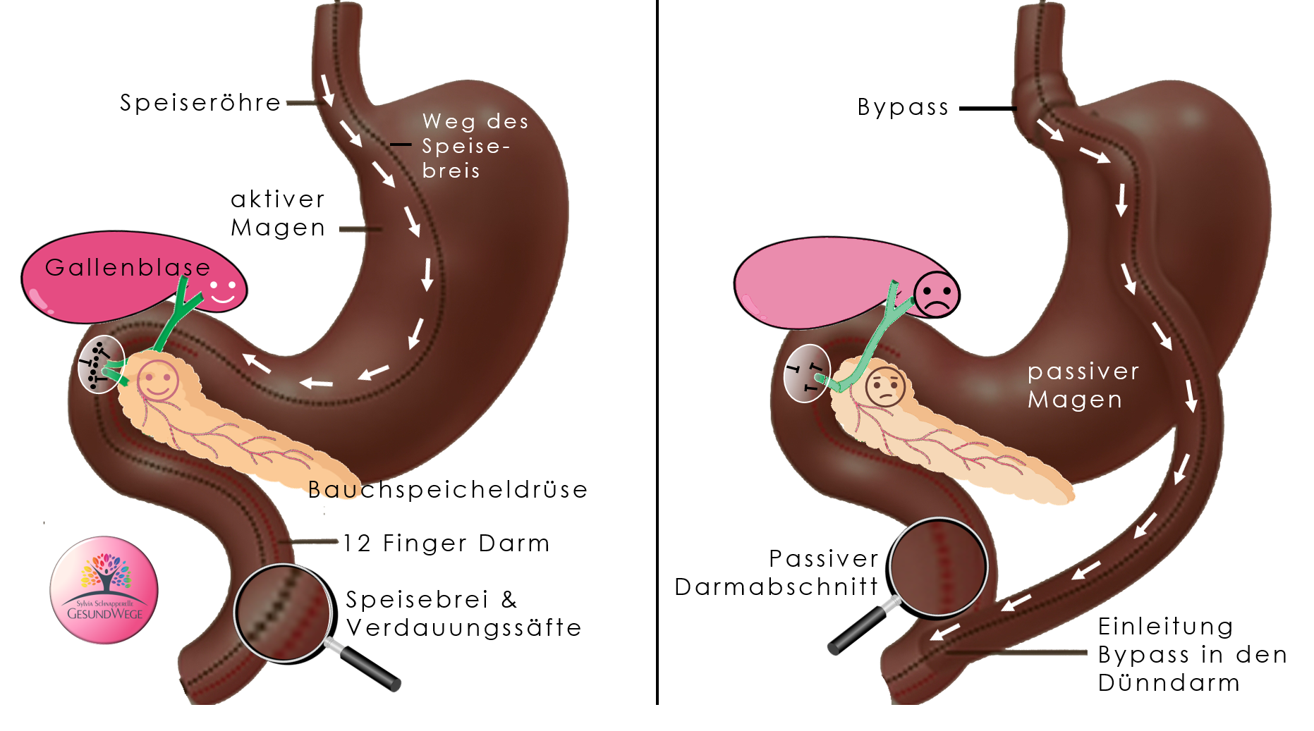 verzichte-auf-magen-bypass-lerne-gesund-und-nachhaltig-fette-abzubauen