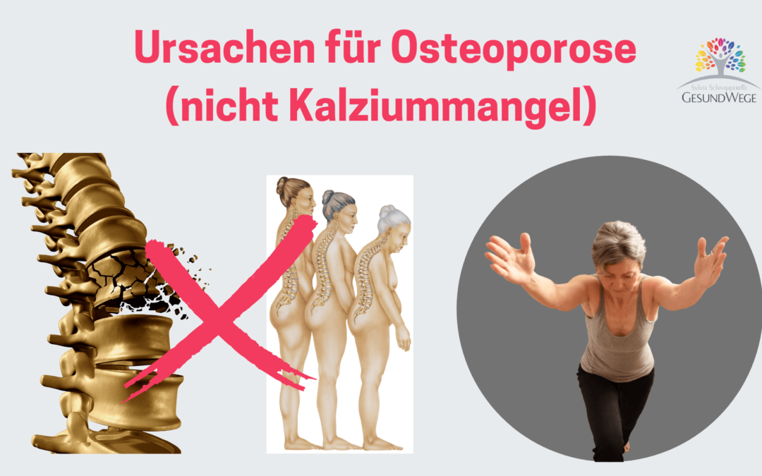 Warum Osteoporose nicht einfach Kalziummangel ist